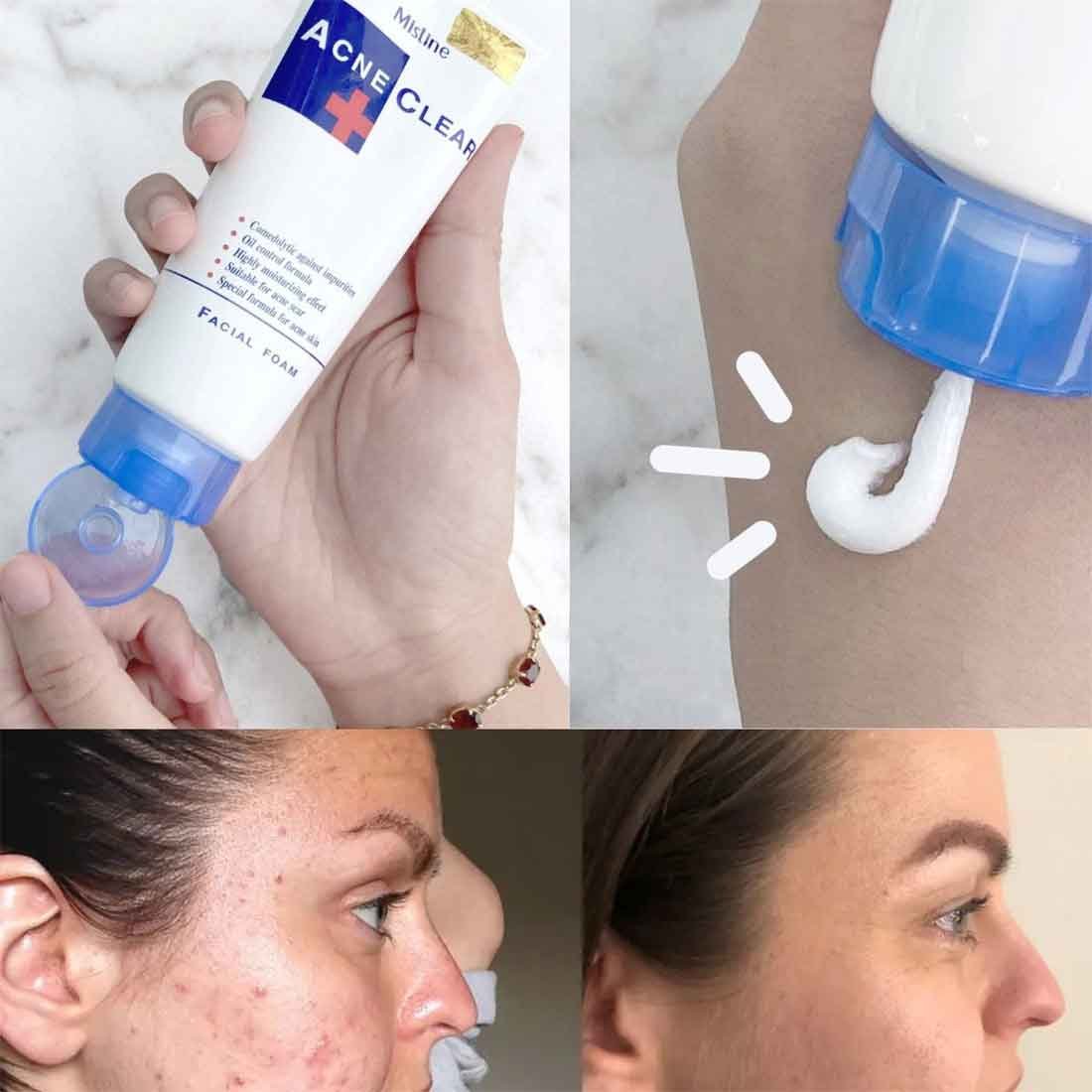 Acne Clear Facial Foam Wash 85ml - Image 3